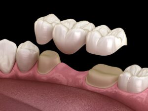分倍河原・中河原（府中市）の歯医者、はんざわ歯科クリニックで保険治療でも「白い歯」に。ブリッジ